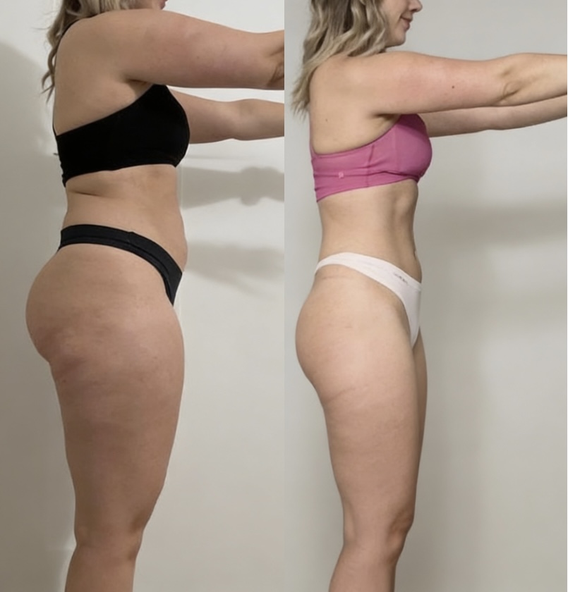 Lidia: prima e dopo il percorso nutrizionale